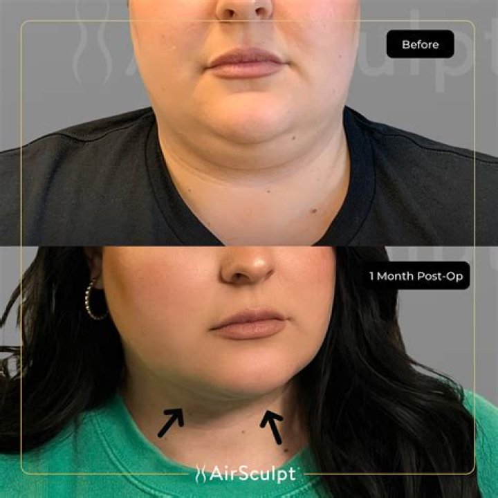 AirSculpt Cost: Factors & Pricing Guide | 2024