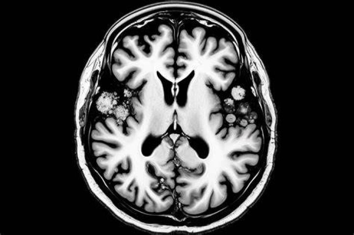 Atpl Brain Disease: Symptoms, Diagnosis & Treatment | [Overview]