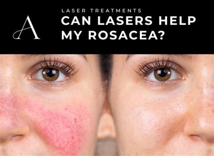 Best Mask for Rosacea: The Ultimate Guide to Soothe and Protect Your Skin