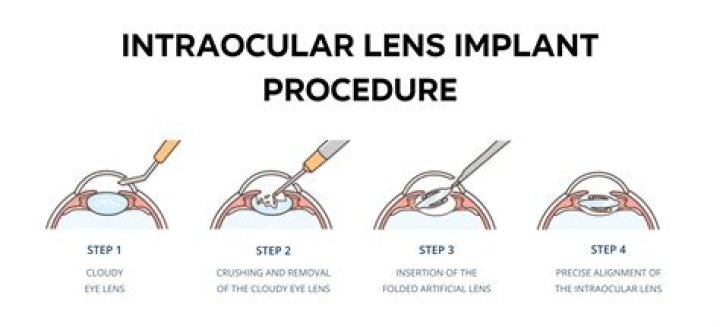 Comprehensive Guide to ICL Definition: Understanding Intraocular Lens Implants