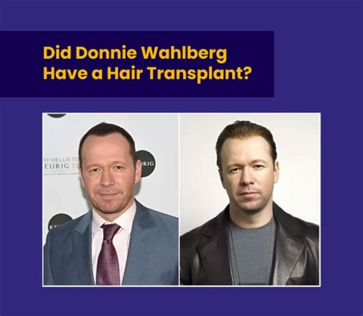 Exploring the Chatter: Did Donnie Wahlberg Get a Hair Transplant?
