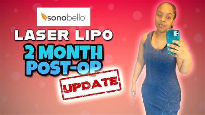 Sono Bello Cost: Prices & What to Expect | Guide