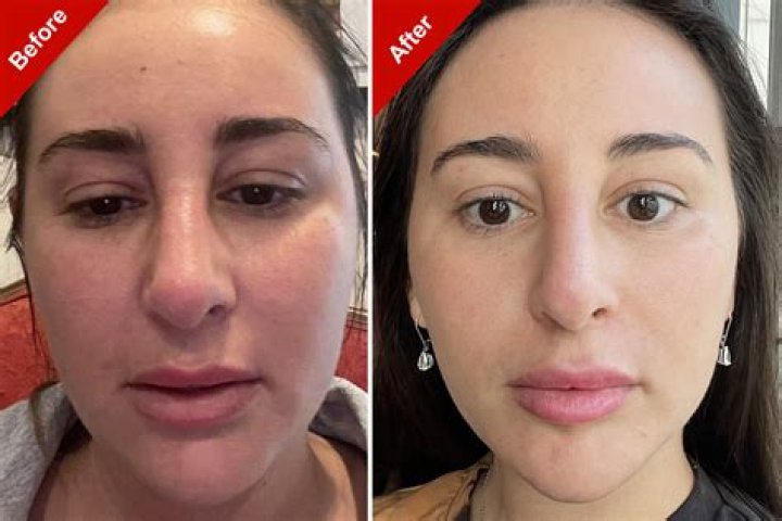 Sono Bello Side Effects: What You Need to Know Before & After