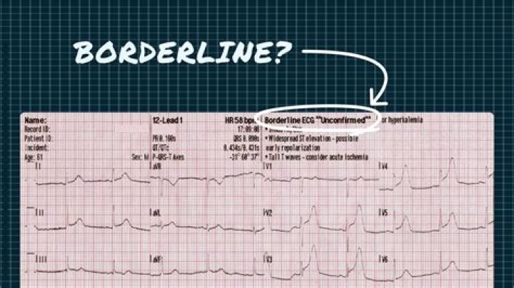 Understanding Borderline ECG: A Comprehensive Guide to Diagnosis, Symptoms, and Management