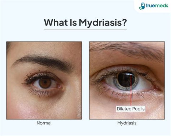 Understanding Dilated Pupils (Mydriasis): Causes & When to Worry