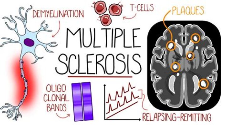 Understanding .ms: A Clear Look at Multiple Sclerosis