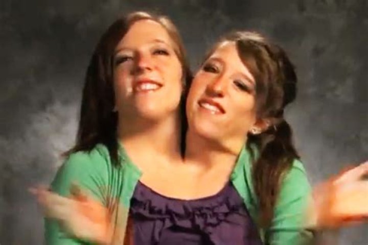 What Happened to Abby and Brittany the Conjoined Twins: A Remarkable Journey
